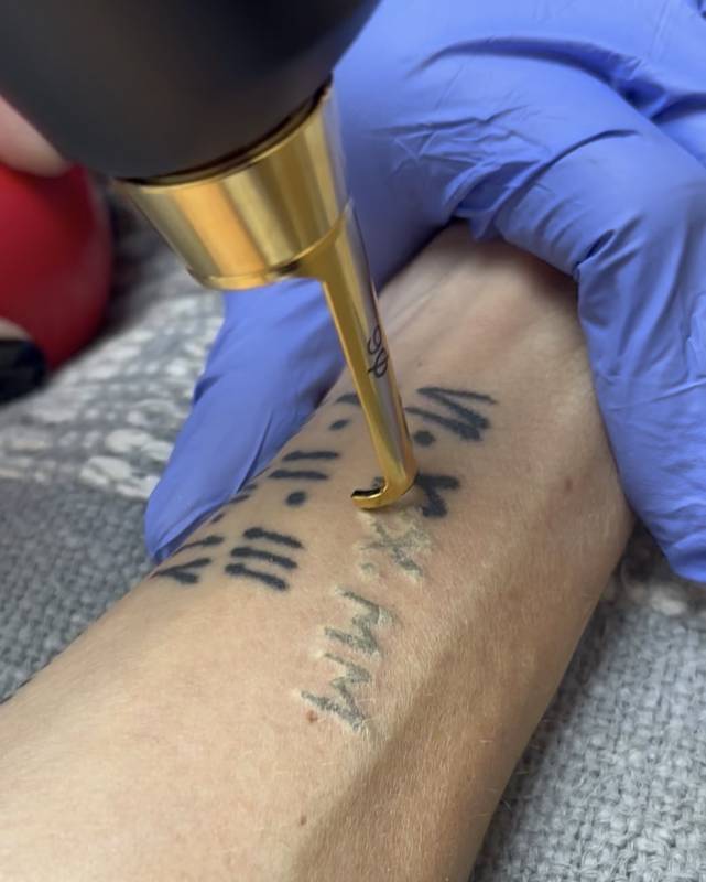 laser tattoo removal